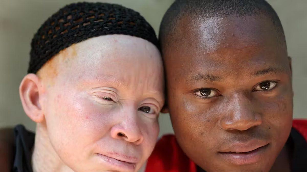 Saç ve Ciltte Renk Farklılığına Neden Olan Albino Hastalığı Nedir, Neden Olur, Kalıtsal mıdır?