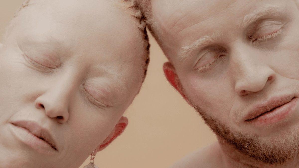 Saç ve Ciltte Renk Farklılığına Neden Olan Albino Hastalığı Nedir, Neden Olur, Kalıtsal mıdır?