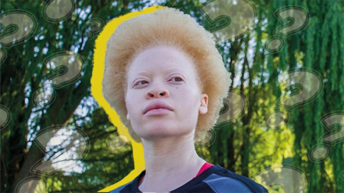 Saç ve Ciltte Renk Farklılığına Neden Olan Albino Hastalığı Nedir, Neden Olur, Kalıtsal mıdır?