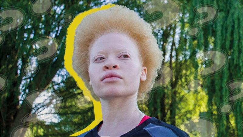 Saç ve Ciltte Renk Farklılığına Neden Olan Albino Hastalığı Nedir, Neden Olur, Kalıtsal mıdır?