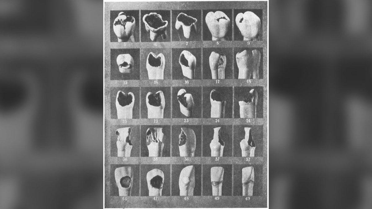 Vipeholm Deneyi: Diş Çürüklerinin Sebebini Keşfetmek Keşke Bu Kadar Acımasızca Olmasaydı!