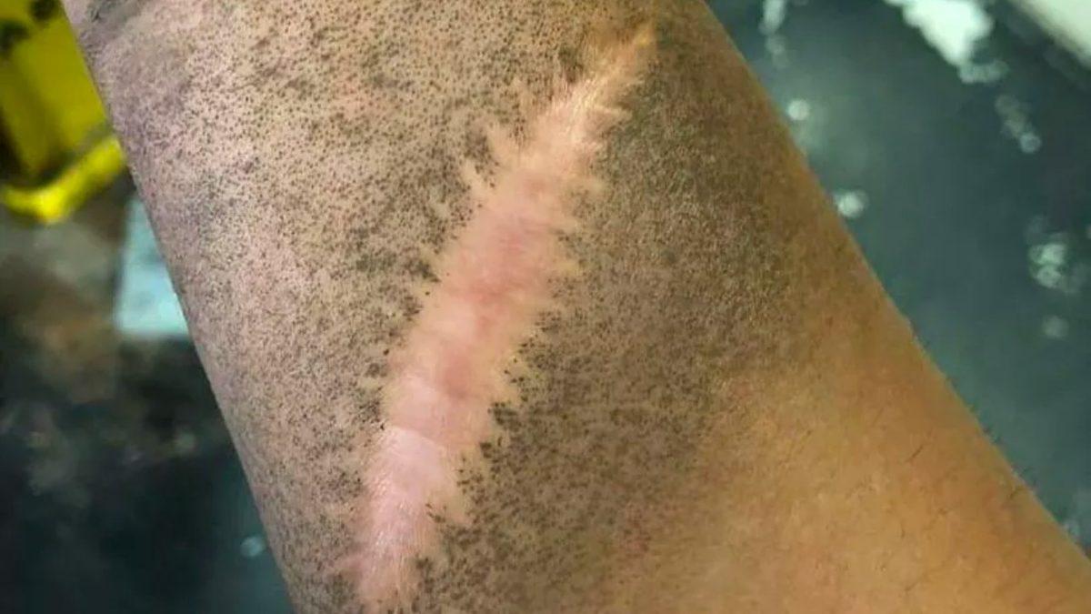 Şimdiye Dek Nasıl Fark Etmemişim Diyeceğiniz İlginç Gerçek: Yara İzleri Neden Toz Tutmaz?