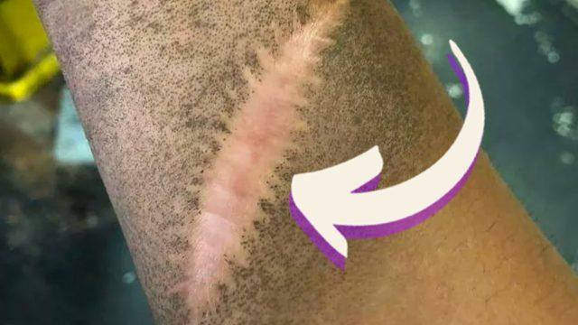 Şimdiye Dek Nasıl Fark Etmemişim Diyeceğiniz İlginç Gerçek: Yara İzleri Neden Toz Tutmaz?