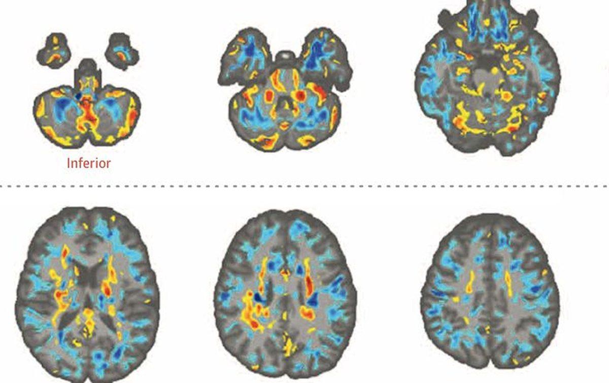 Küba’daki Amerikalı Diplomatların Beyinlerinde Hasar Bırakan ve Sebebi Senelerdir Çözülemeyen Olay: Havana Sendromu
