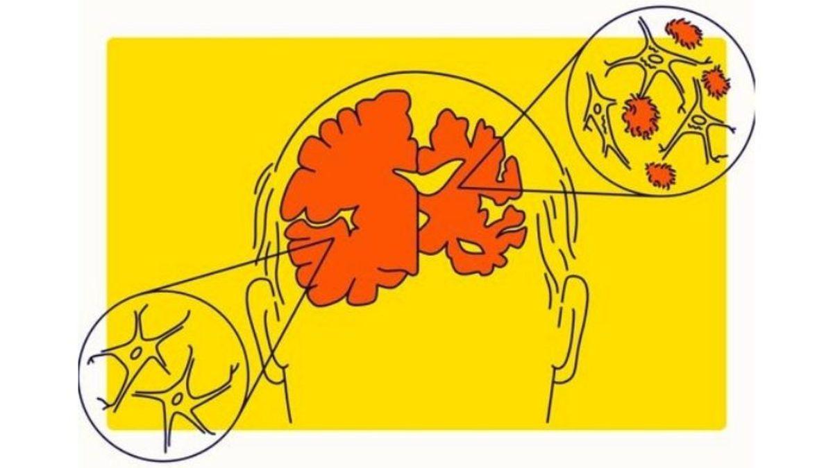 Alzheimer Tedavisinde Umut Verici Gelişme: Hastalığı Teşhis Edebilecek Kan Testi Kitleri Geliştirildi
