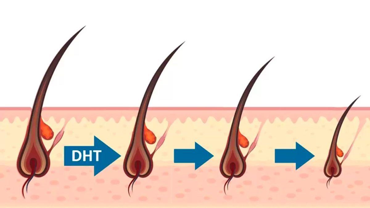 Şimdiye Kadar Neredeyse Hiç Kel Kadın Görmemenizin Asıl Sebebi Ne? İşte İçimizdeki O Kilit Faktör...