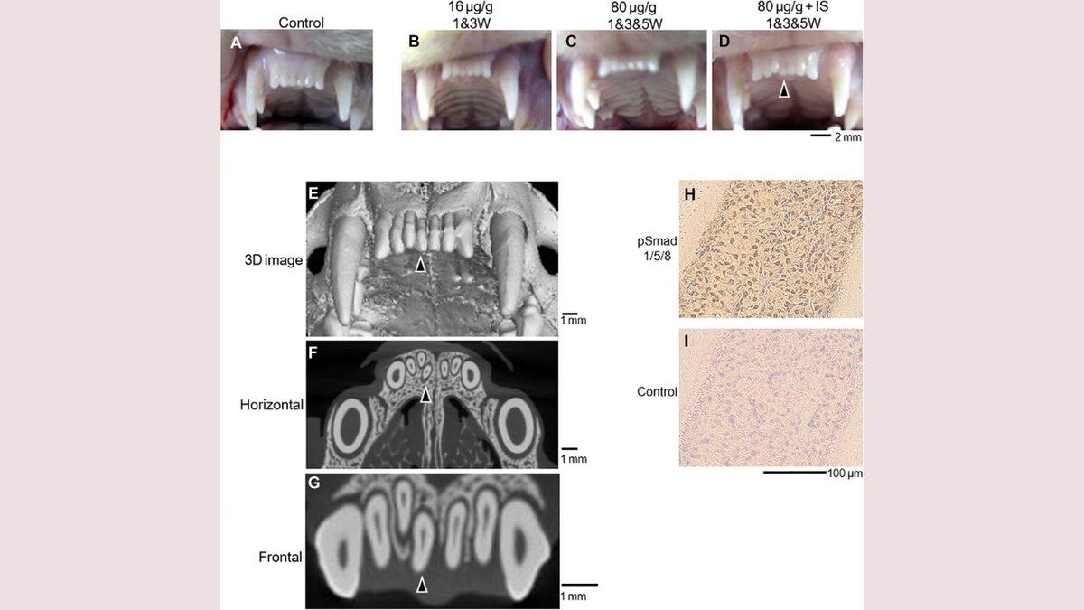 Müjdemizi İsteriz: Kaybettiğiniz Dişlerin Yenisinin Çıkması 