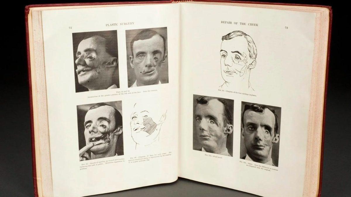 Bugün Burun Estetiği Yaptırabiliyorsanız Nedeni Aslında I. Dünya Savaşı’dır: İşte Plastik Cerrahinin Ortaya Çıkış Öyküsü