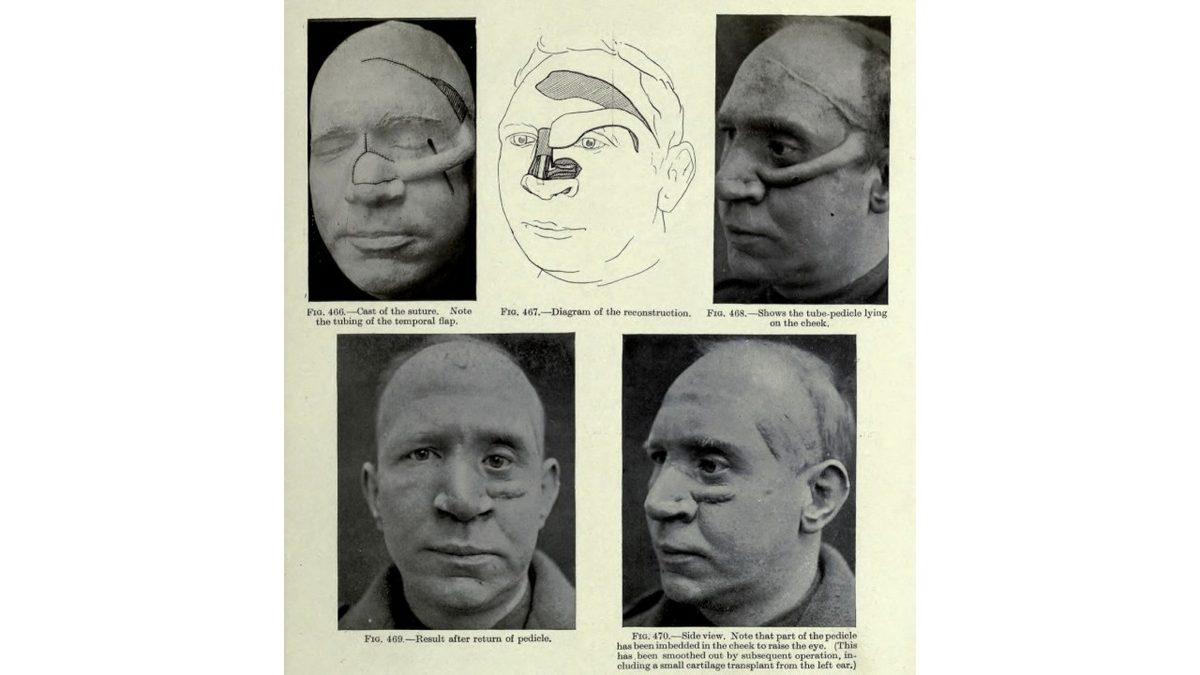 Bugün Burun Estetiği Yaptırabiliyorsanız Nedeni Aslında I. Dünya Savaşı’dır: İşte Plastik Cerrahinin Ortaya Çıkış Öyküsü