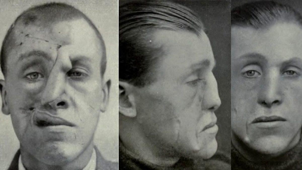 Bugün Burun Estetiği Yaptırabiliyorsanız Nedeni Aslında I. Dünya Savaşı’dır: İşte Plastik Cerrahinin Ortaya Çıkış Öyküsü