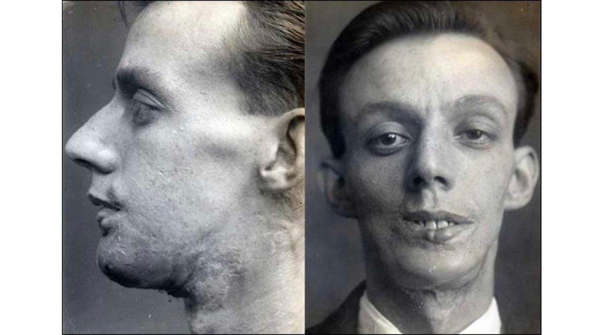 Bugün Burun Estetiği Yaptırabiliyorsanız Nedeni Aslında I. Dünya Savaşı’dır: İşte Plastik Cerrahinin Ortaya Çıkış Öyküsü