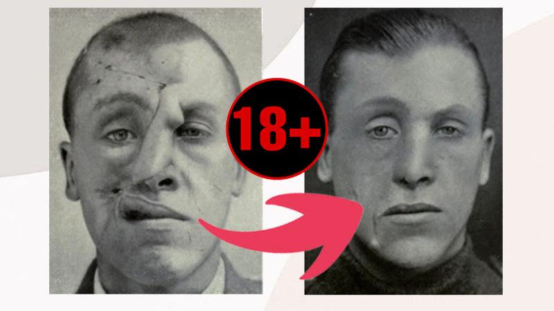 Bugün Burun Estetiği Yaptırabiliyorsanız Nedeni Aslında I. Dünya Savaşı’dır: İşte Plastik Cerrahinin Ortaya Çıkış Öyküsü