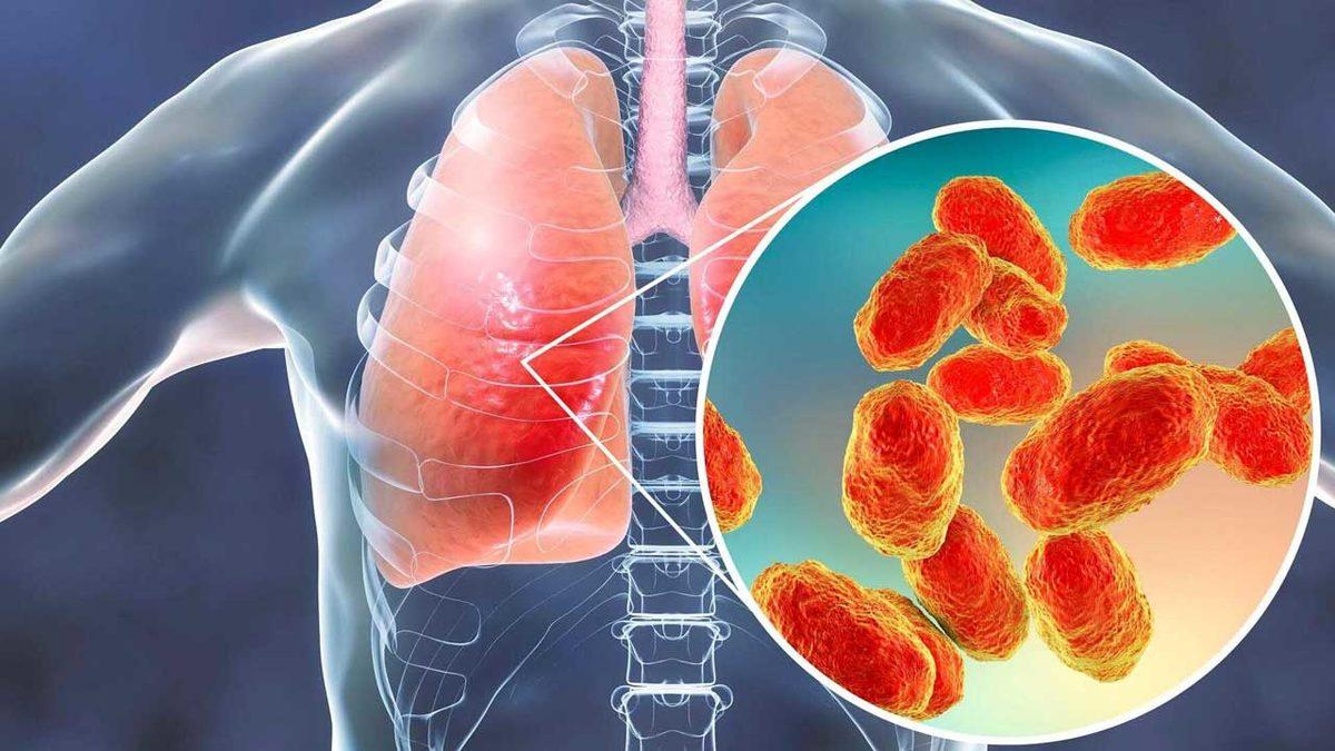 Yanlışlıkla Akciğerlerimize Kaçan Yiyecekler Hep Orada mı Kalır Yoksa Zamanla Kaybolur mu?