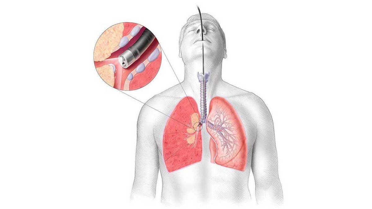 Yanlışlıkla Akciğerlerimize Kaçan Yiyecekler Hep Orada mı Kalır Yoksa Zamanla Kaybolur mu?