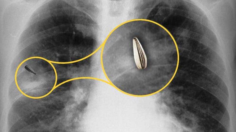 Yanlışlıkla Akciğerlerimize Kaçan Yiyecekler Hep Orada mı Kalır Yoksa Zamanla Kaybolur mu?