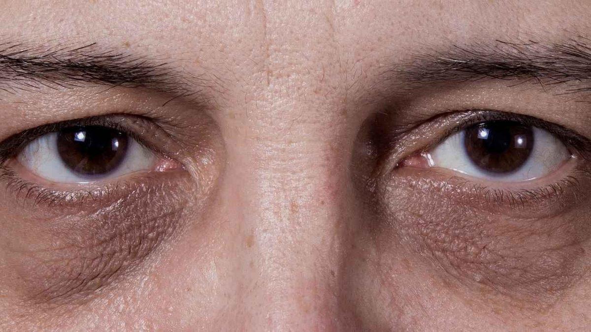 Tek Sebebi Uykusuzluk ya da Yorgunluk Değil: Göz Altı Morlukları Neden Olur, Nasıl Geçer?