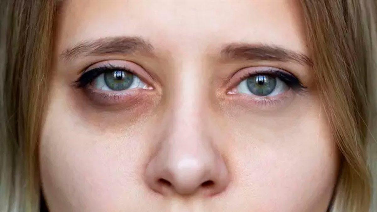 Tek Sebebi Uykusuzluk ya da Yorgunluk Değil: Göz Altı Morlukları Neden Olur, Nasıl Geçer?