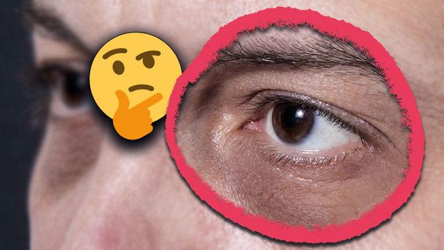 Tek Sebebi Uykusuzluk ya da Yorgunluk Değil: Göz Altı Morlukları Neden Olur, Nasıl Geçer?