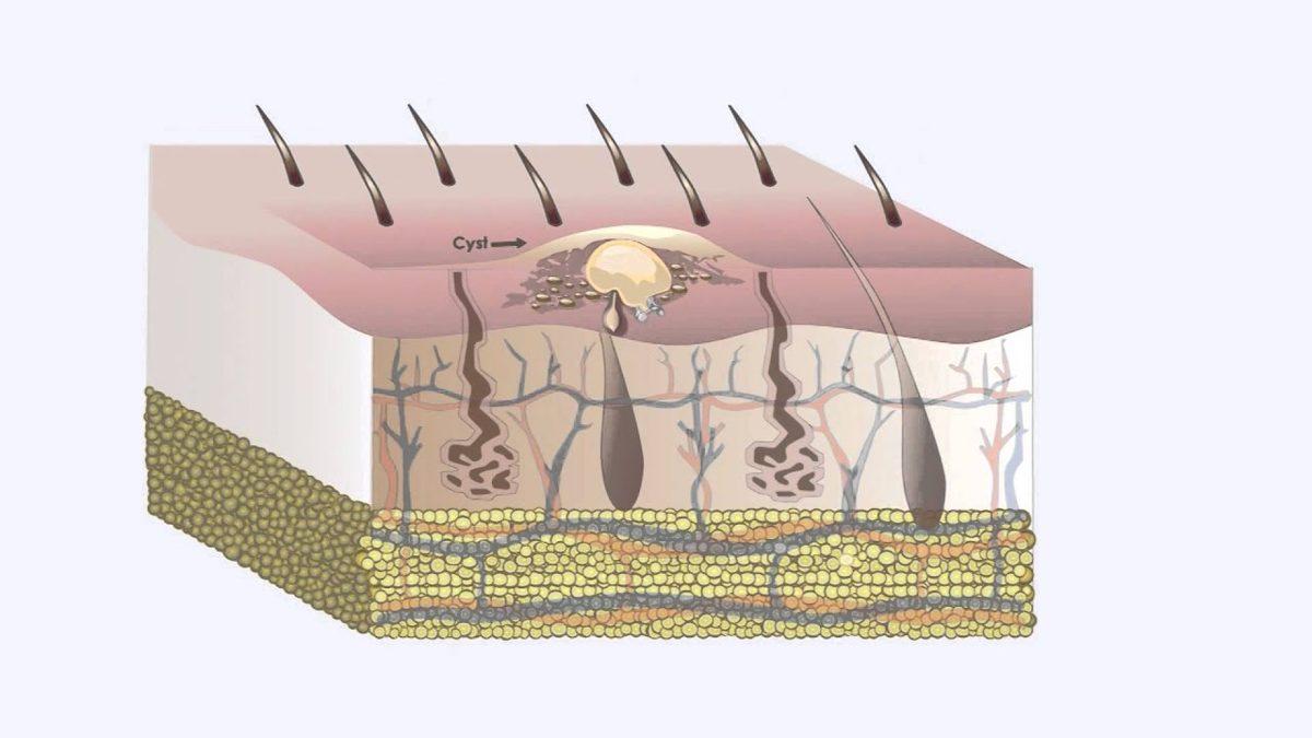 Ciddi Rahatsızlıkların Habercisi Olabildiği İçin Dikkat Etmemiz Gereken ’Kist’ Tam Olarak Nedir, Neden Olur?