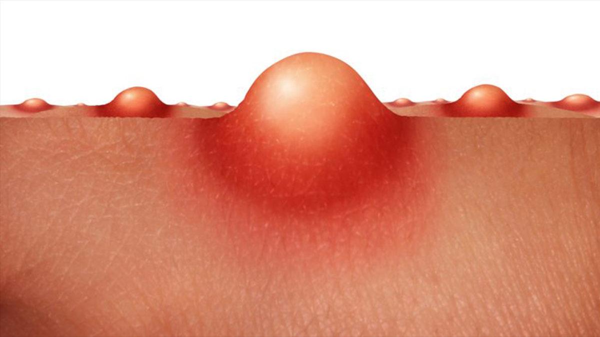 Ciddi Rahatsızlıkların Habercisi Olabildiği İçin Dikkat Etmemiz Gereken ’Kist’ Tam Olarak Nedir, Neden Olur?