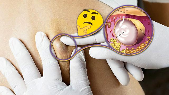 Ciddi Rahatsızlıkların Habercisi Olabildiği İçin Dikkat Etmemiz Gereken ’Kist’ Tam Olarak Nedir, Neden Olur?