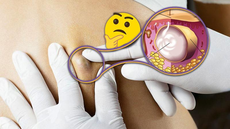 Ciddi Rahatsızlıkların Habercisi Olabildiği İçin Dikkat Etmemiz Gereken ’Kist’ Tam Olarak Nedir, Neden Olur?