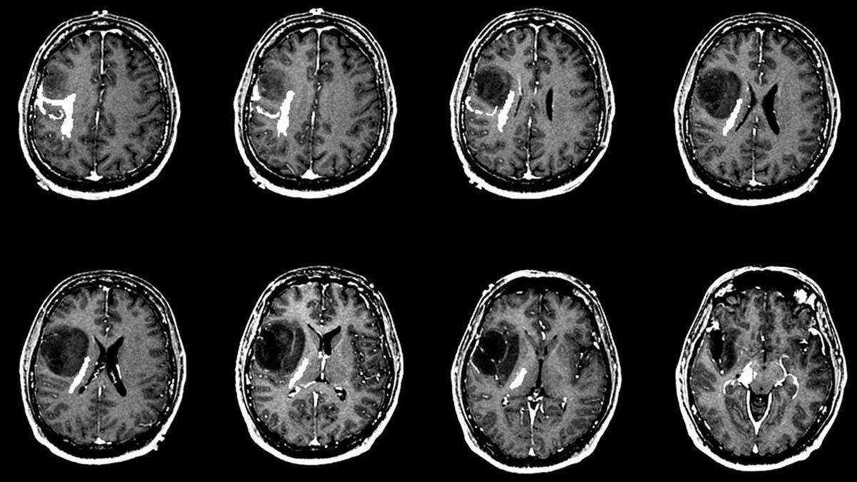 Nasıl Oluyor da Hastalar Uyanık Hâldeyken Bile Beyin Ameliyatı Yapılabiliyor? Dolma Dolduran Bile Var!