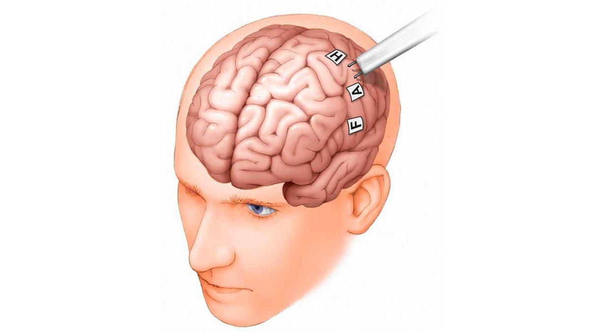 Nasıl Oluyor da Hastalar Uyanık Hâldeyken Bile Beyin Ameliyatı Yapılabiliyor? Dolma Dolduran Bile Var!