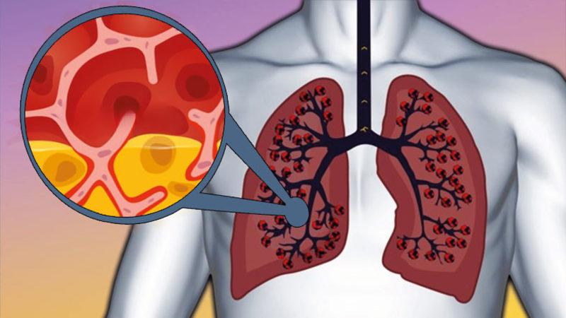 Öksüre Öksüre İnsanı Canından Bezdiren ’Balgam’ Neden Olur, Nasıl Geçer?
