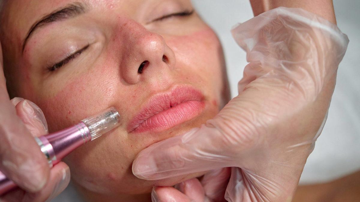 Seda Sayan’ın da Yüzüne Enjekte Ettirdiği 