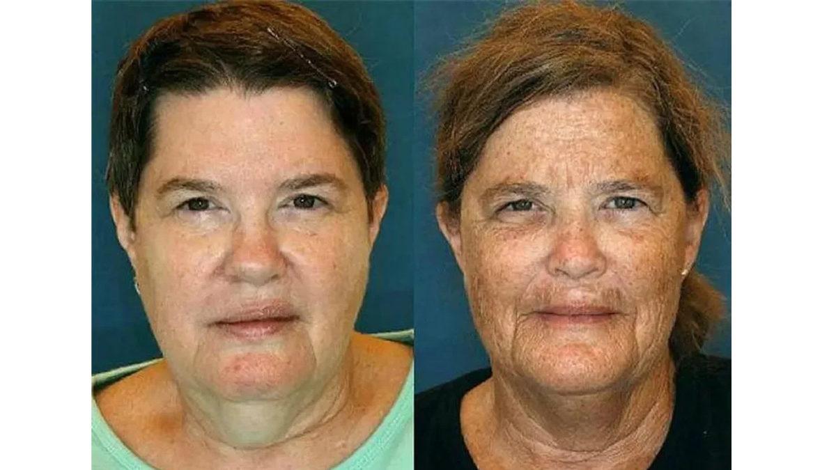 Yüzlerindeki Kırışıklıkların Karşılaştırıldığı İkizlerden Hangilerinin Sigara İçtiğini Tahmin Edebilir misin?