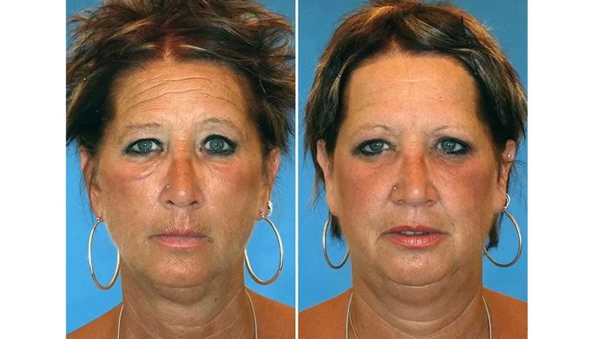 Yüzlerindeki Kırışıklıkların Karşılaştırıldığı İkizlerden Hangilerinin Sigara İçtiğini Tahmin Edebilir misin?