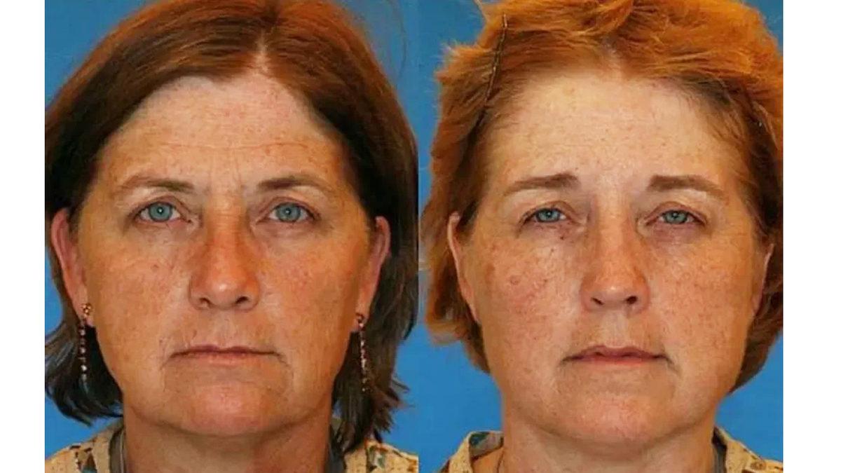 Yüzlerindeki Kırışıklıkların Karşılaştırıldığı İkizlerden Hangilerinin Sigara İçtiğini Tahmin Edebilir misin?