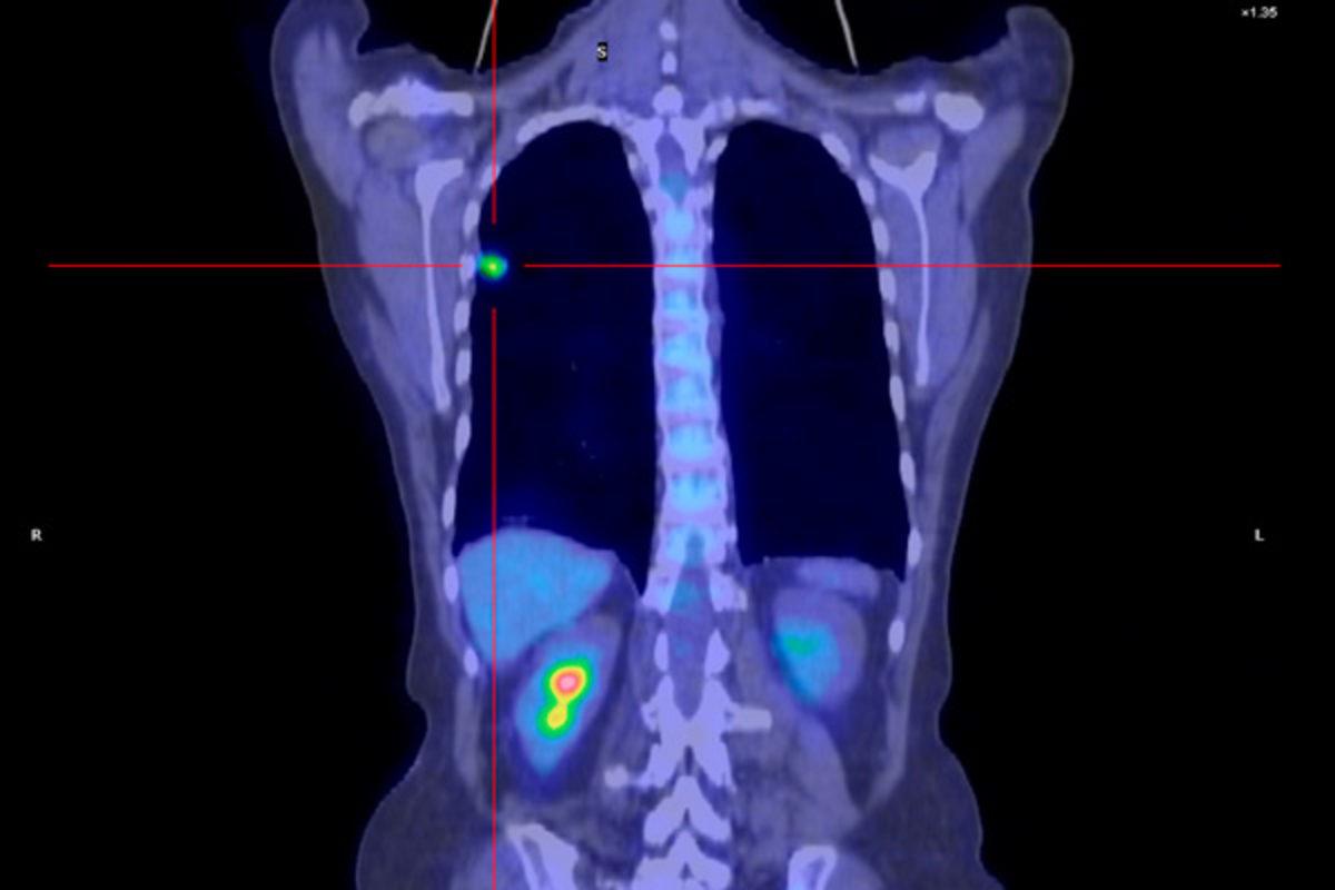 Sigarayı Bırakanların Ciğerleri Tam Anlamıyla Düzeliyor Mu?