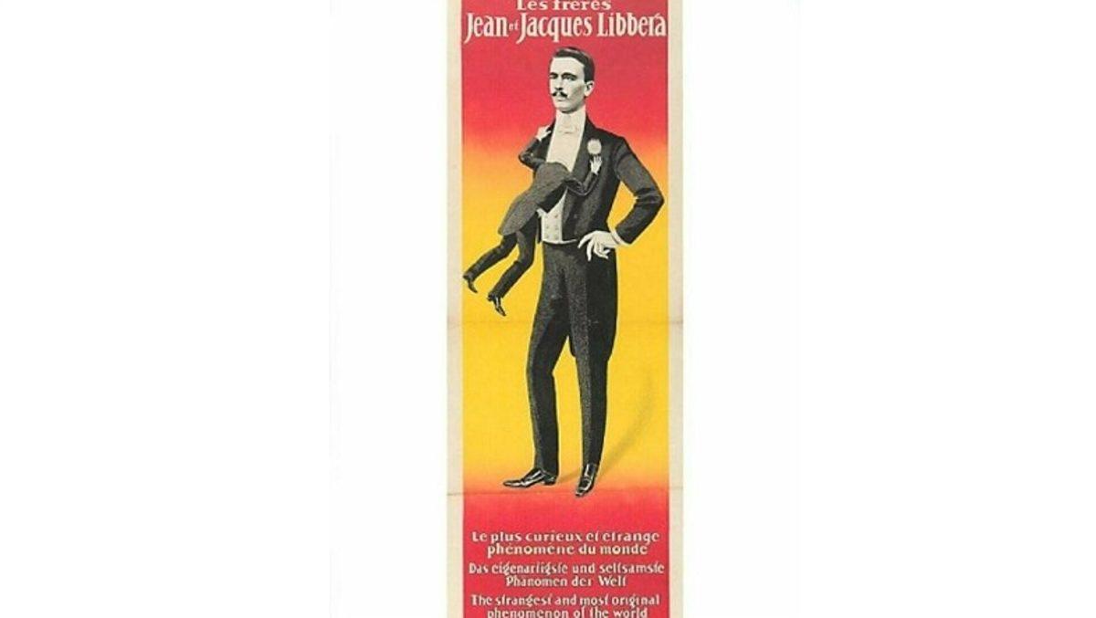Karnına Yapışık Parazit İkizini Taşıdığı İçin Sirklerde Sergilenen Adam: Jean Libbera