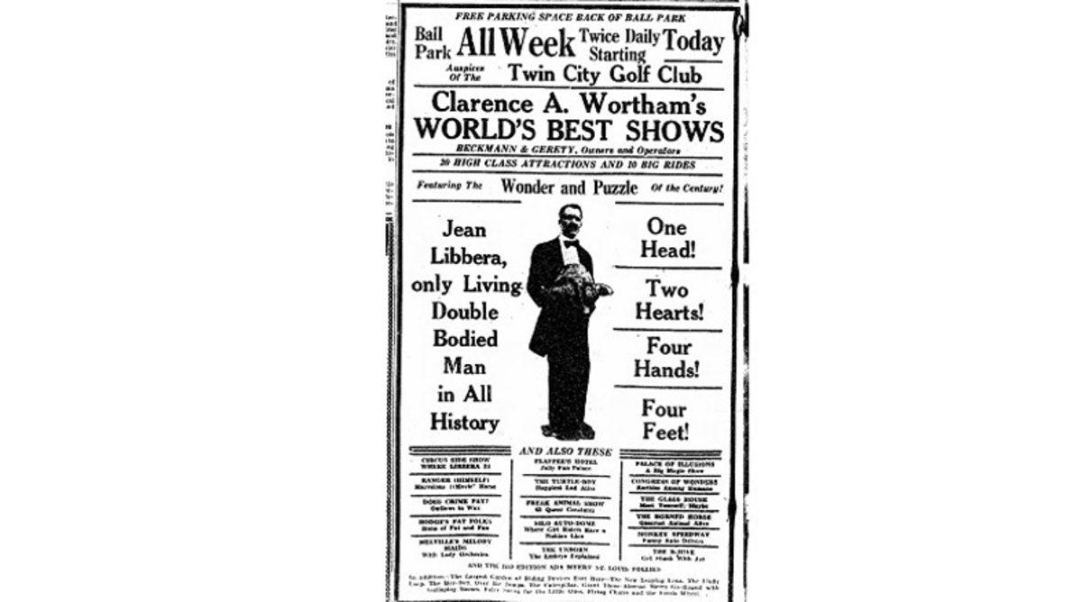 Karnına Yapışık Parazit İkizini Taşıdığı İçin Sirklerde Sergilenen Adam: Jean Libbera