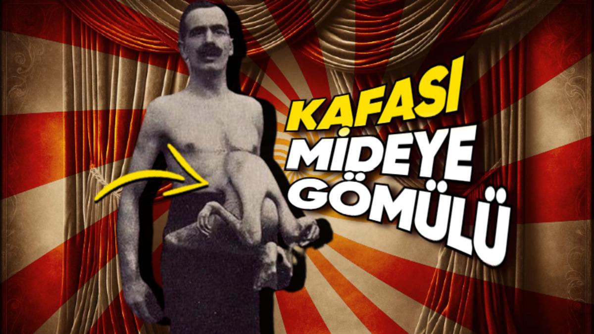 Karnına Yapışık Parazit İkizini Taşıdığı İçin Sirklerde Sergilenen Adam: Jean Libbera