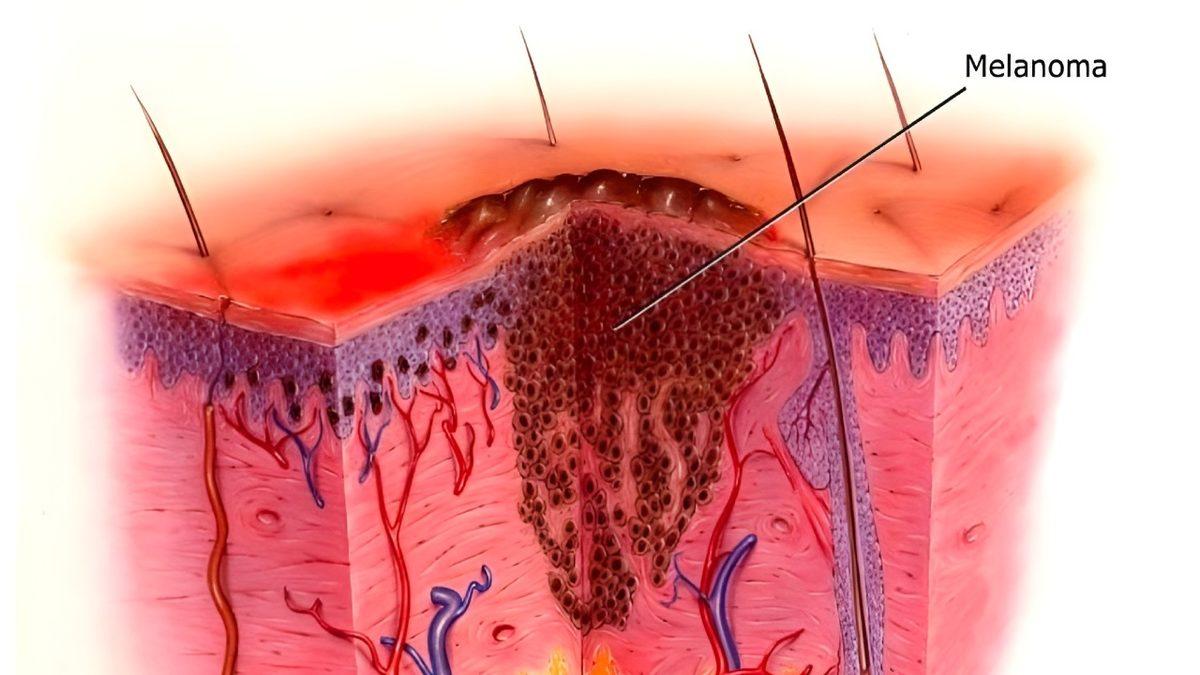İsrail’de Yaşayanların Bir Dönem Cilt Kanserine Çok Fazla Yakalanmasının Düşündürücü Sebebi
