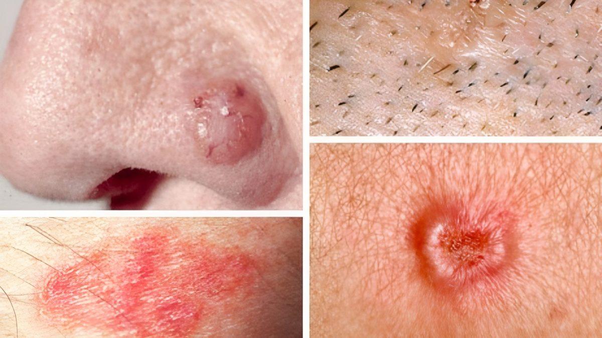 İsrail’de Yaşayanların Bir Dönem Cilt Kanserine Çok Fazla Yakalanmasının Düşündürücü Sebebi