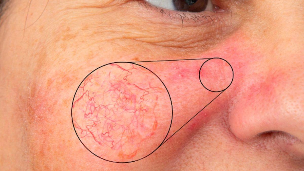 İsrail’de Yaşayanların Bir Dönem Cilt Kanserine Çok Fazla Yakalanmasının Düşündürücü Sebebi