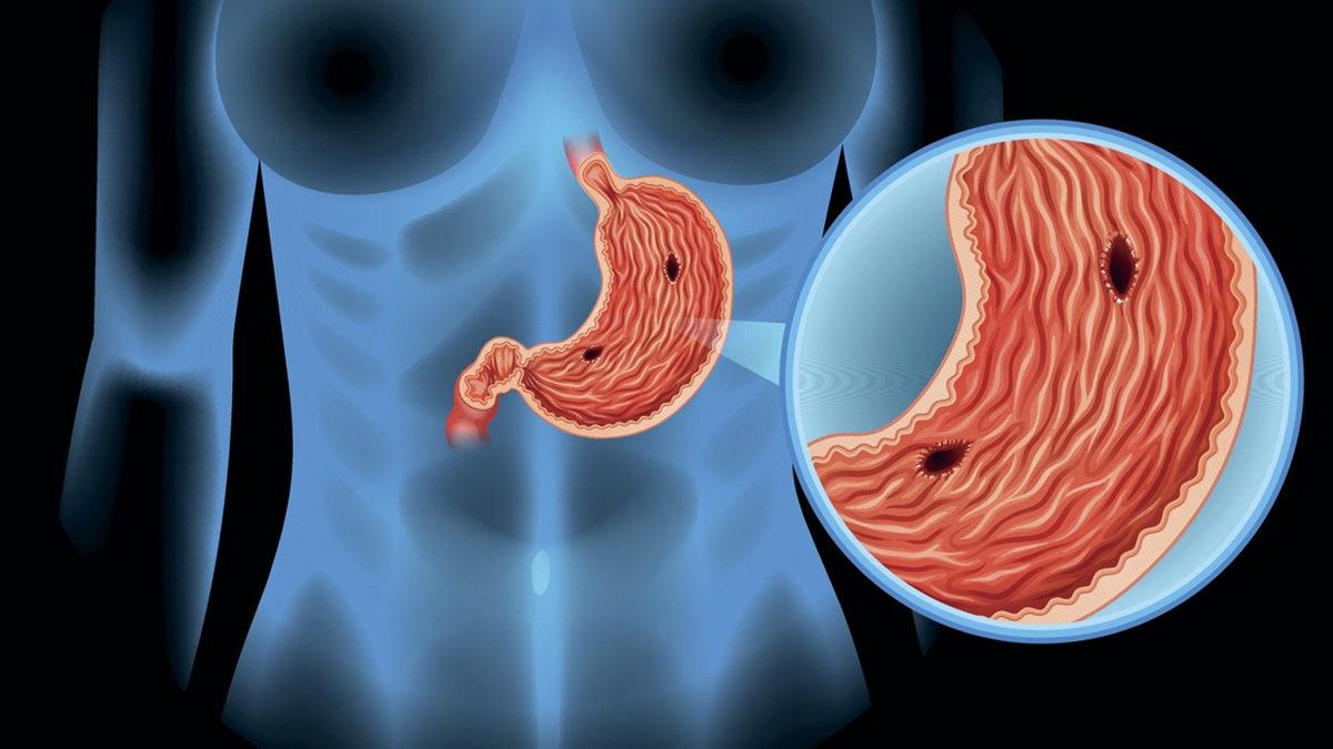 Midenizde Sıklıkla Ağrı ve Yanma Hissediyorsanız Nedeni Bu Olabilir: Ülser Nedir, Belirtileri Nelerdir?