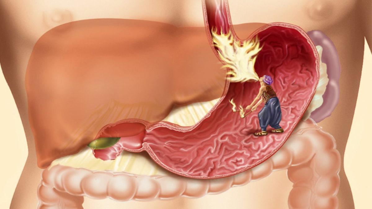 Midenizde Sıklıkla Ağrı ve Yanma Hissediyorsanız Nedeni Bu Olabilir: Ülser Nedir, Belirtileri Nelerdir?