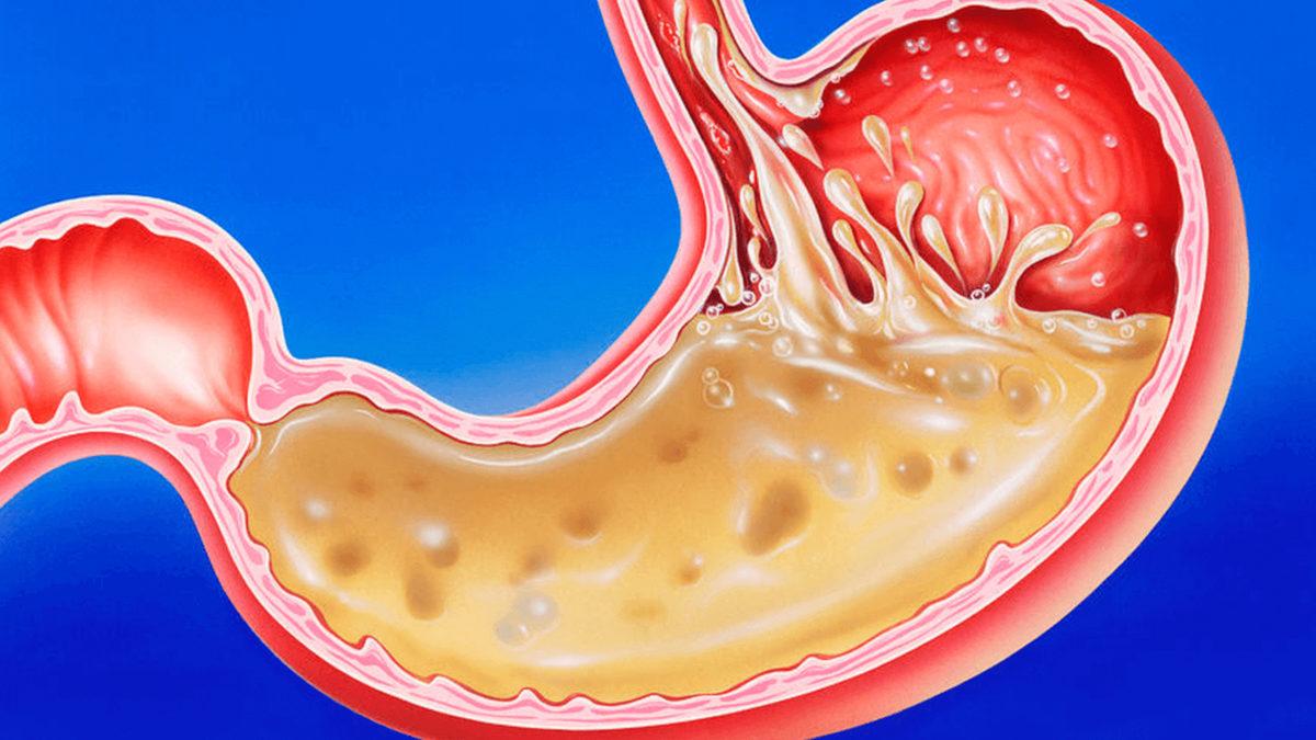 Midenizde Sıklıkla Ağrı ve Yanma Hissediyorsanız Nedeni Bu Olabilir: Ülser Nedir, Belirtileri Nelerdir?