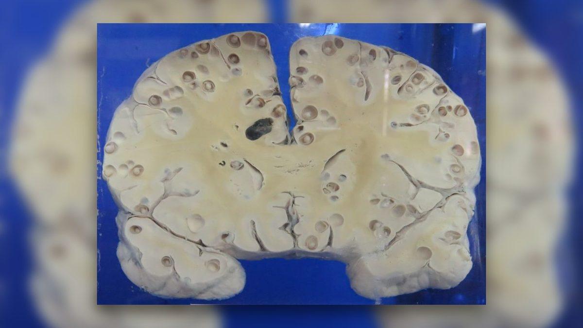 Beyin MR’ındaki Bu Noktaların Ne Olduğunu Öğrenince Yemek Yaparken İki Kez Düşüneceksiniz