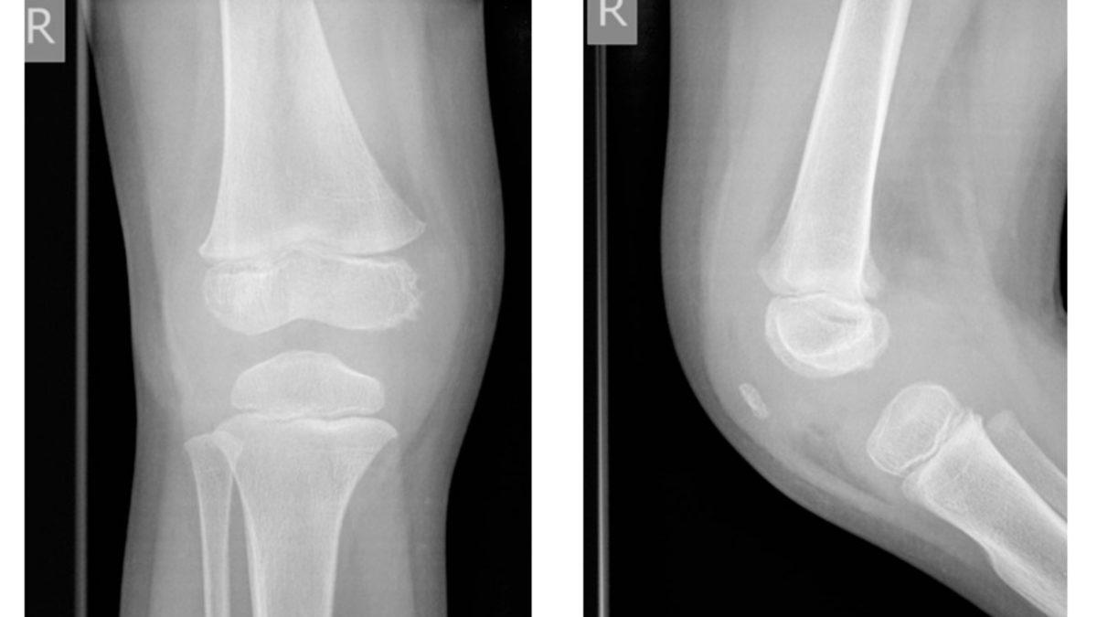 Bebeklerin Diz Kapakları Röntgen Filminde Neden Görünmez?