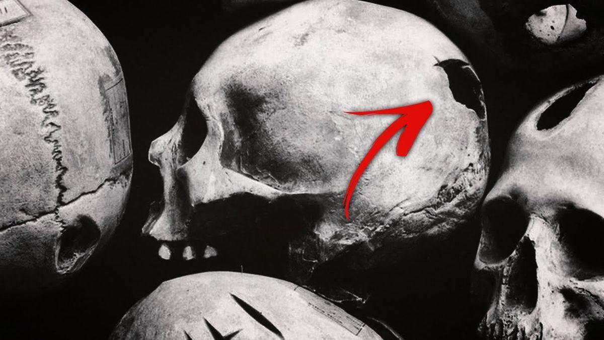 Anestezi Diye Bir Şey Yokken Ameliyatlar Nasıl Yapılıyordu? (Okuyunca İyi ki O Tarihlerde Yaşamamışız Diyeceksiniz)