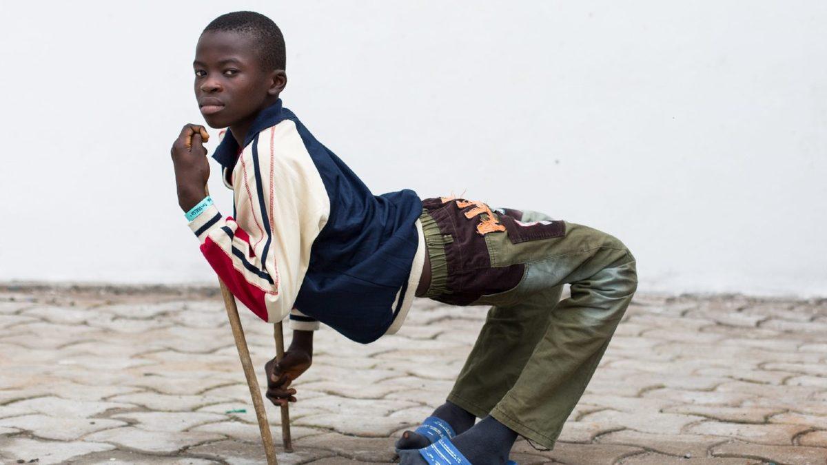 Vücudun Kâğıt Gibi İkiye Katlanmasına Sebep Olan Rahatsız Edici Hastalık: Kuadriseps Kontraktürü