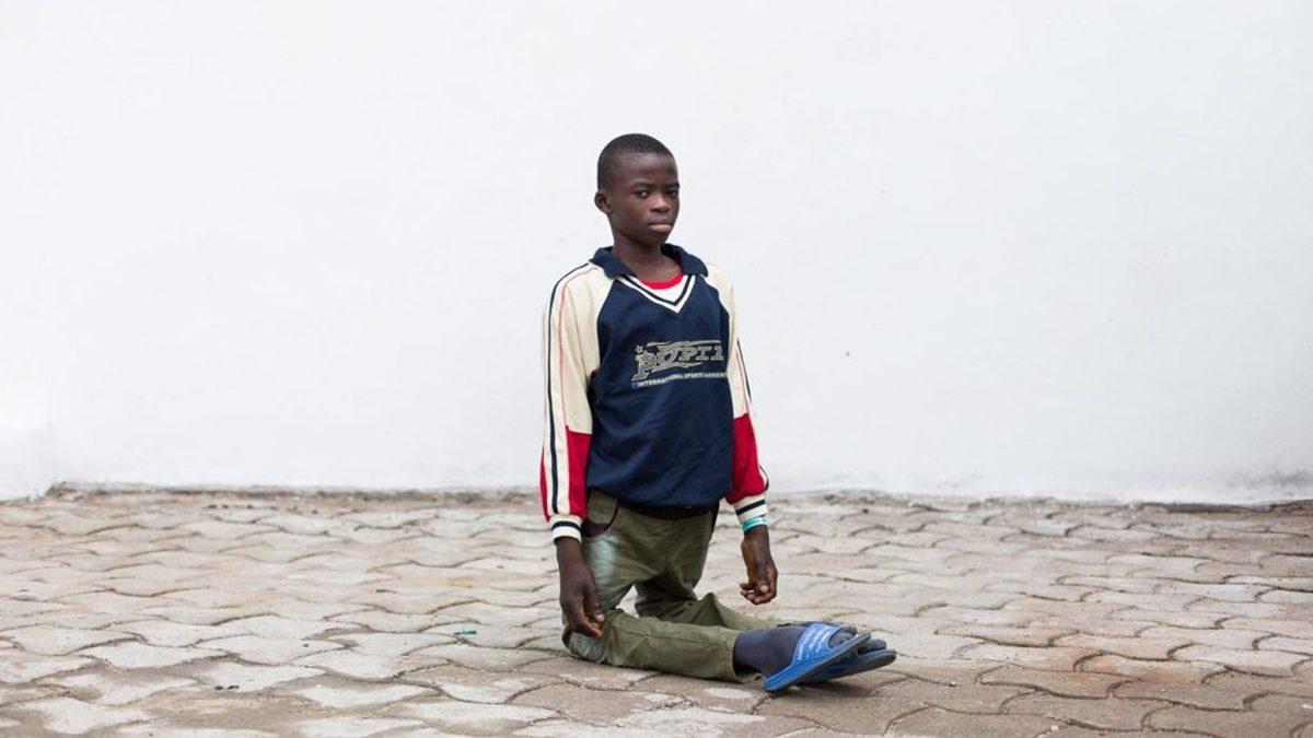 Vücudun Kâğıt Gibi İkiye Katlanmasına Sebep Olan Rahatsız Edici Hastalık: Kuadriseps Kontraktürü