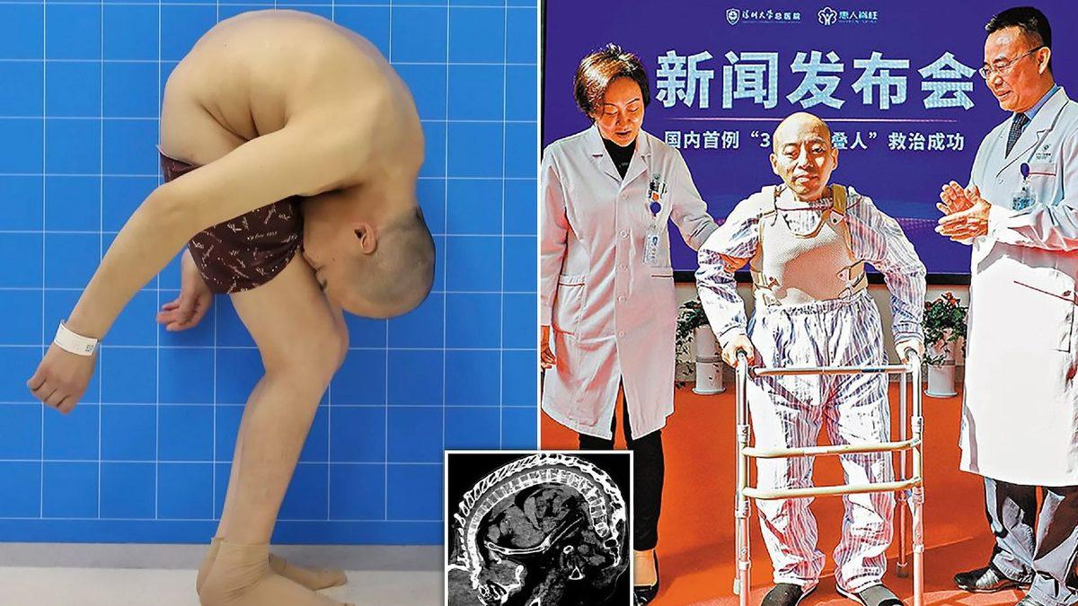 Vücudun Kâğıt Gibi İkiye Katlanmasına Sebep Olan Rahatsız Edici Hastalık: Kuadriseps Kontraktürü