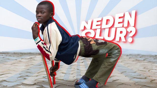 Vücudun Kâğıt Gibi İkiye Katlanmasına Sebep Olan Rahatsız Edici Hastalık: Kuadriseps Kontraktürü